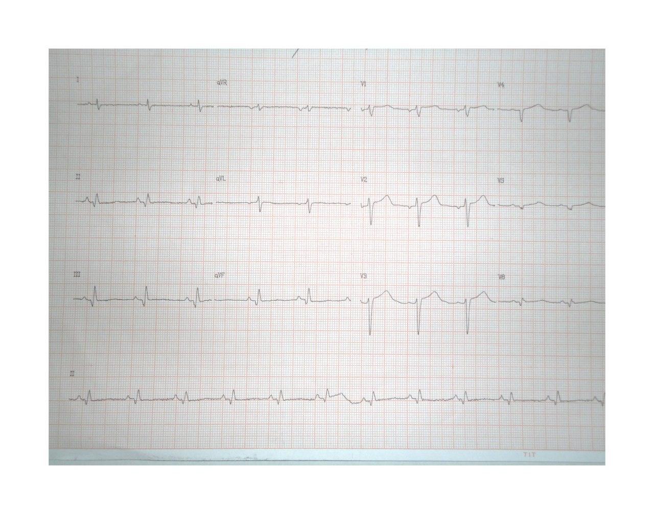 Paciente masculino portador de miocardiopatía crónica chagásica que presentó episodio sincopal por taquicardia de QRS ancho que se controla con CVE observándose en el ECG área de necrosis o fibrosis ínferolateral y presencia de aneurisma con trombo apical