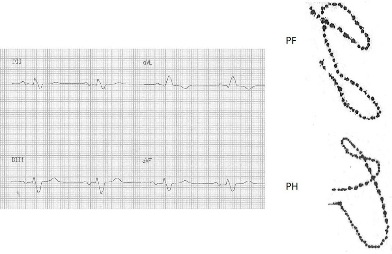 Trazado VCG donde se observa bucle de onda P correspondiente a un BIA-A