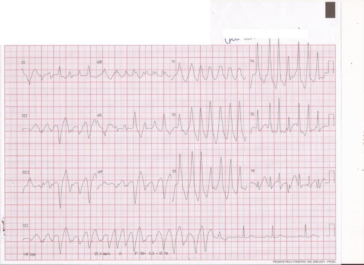 Hombre de 75 años con palpitaciones y mareos en el que se constata TV polimórfica cuyo foco se localiza y ablaciona exitosamente producto de secuela de miocarditis constatada por RNM