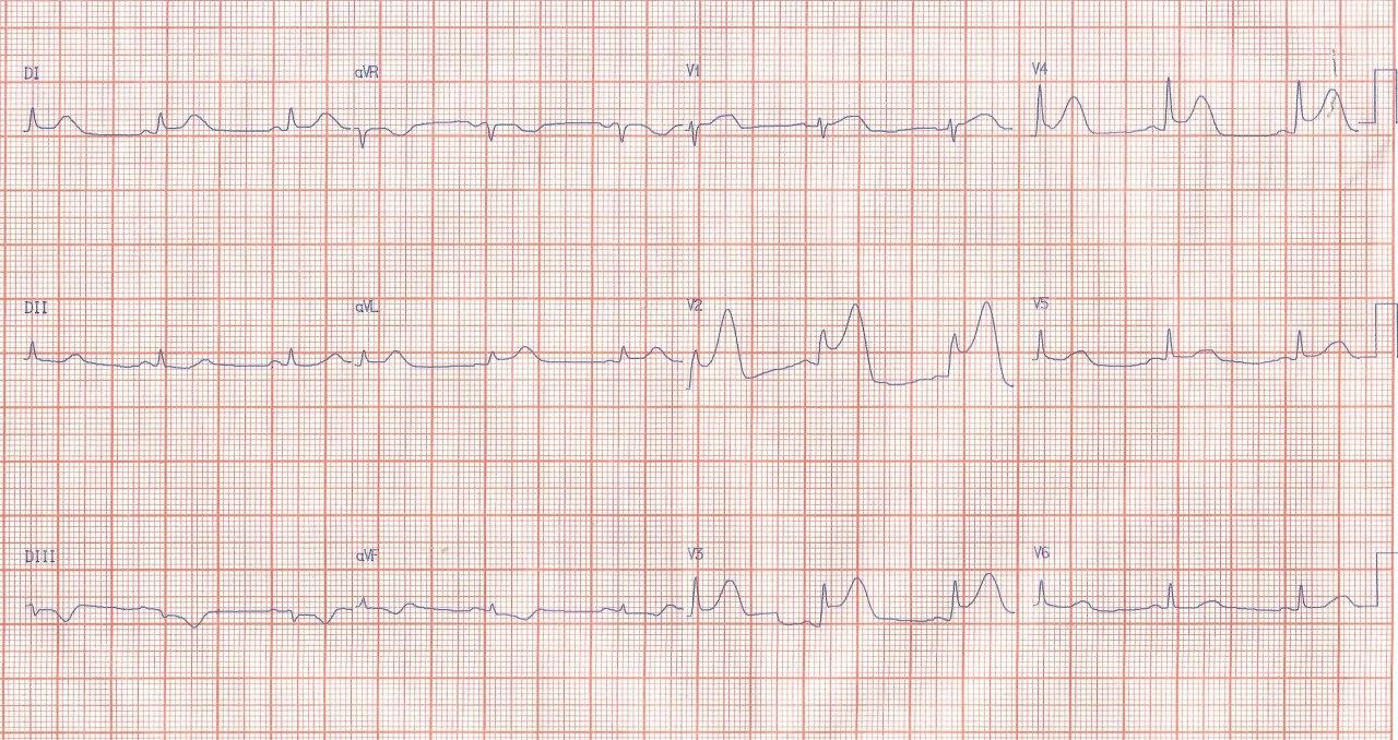 Mujer de 55 años, hipertensa y fumadora que presenta angor prolongado por oclusión de la DA proximal