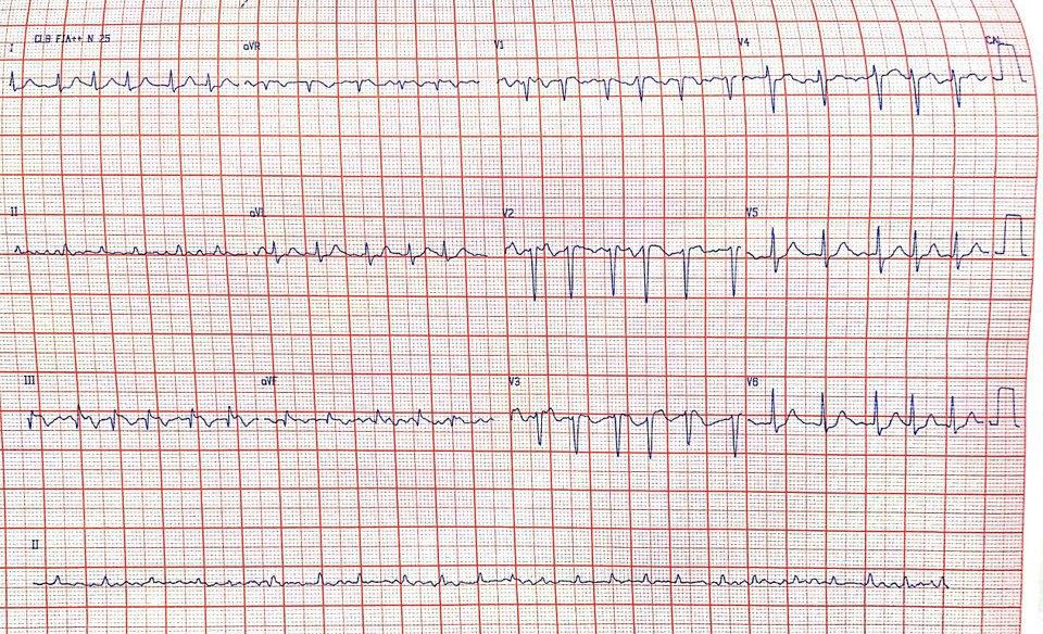 Paciente que hace una semana presentó fiebre, disnea y tos en cuyo ECG se observa patrón S1Q3T3 sugestivo de hipertensión pulmonar en contexto de TEP por trombo en aurícula derecha y foramen oval permeable