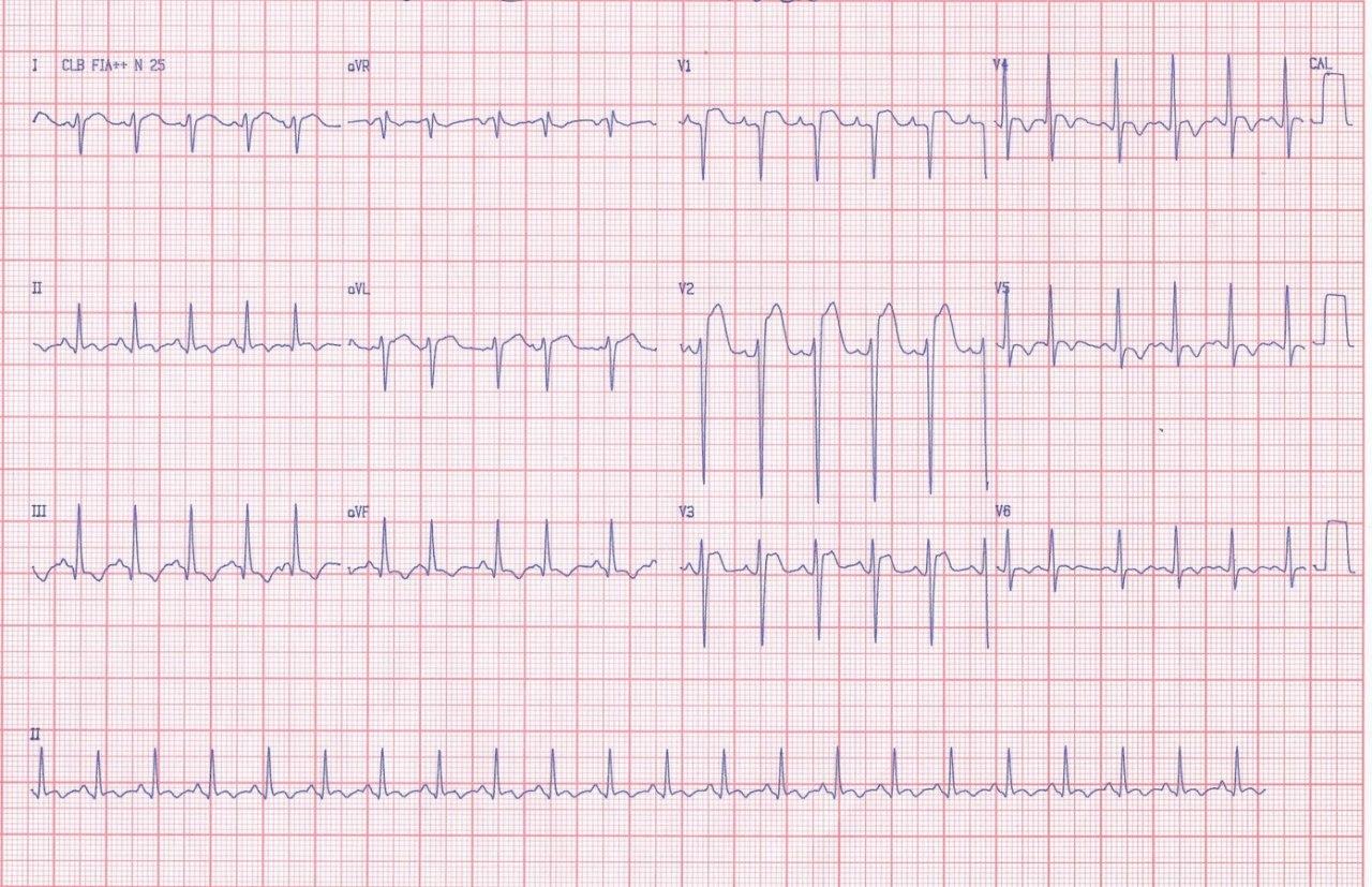 Paciente de 23 años portador de Enfermedad de Duchenne familiar con fatiga y disnea progresivas que presenta hipocinesia difusa y BDPI con el segundo vector que se dirige tardíamente abajo y algo a la derecha