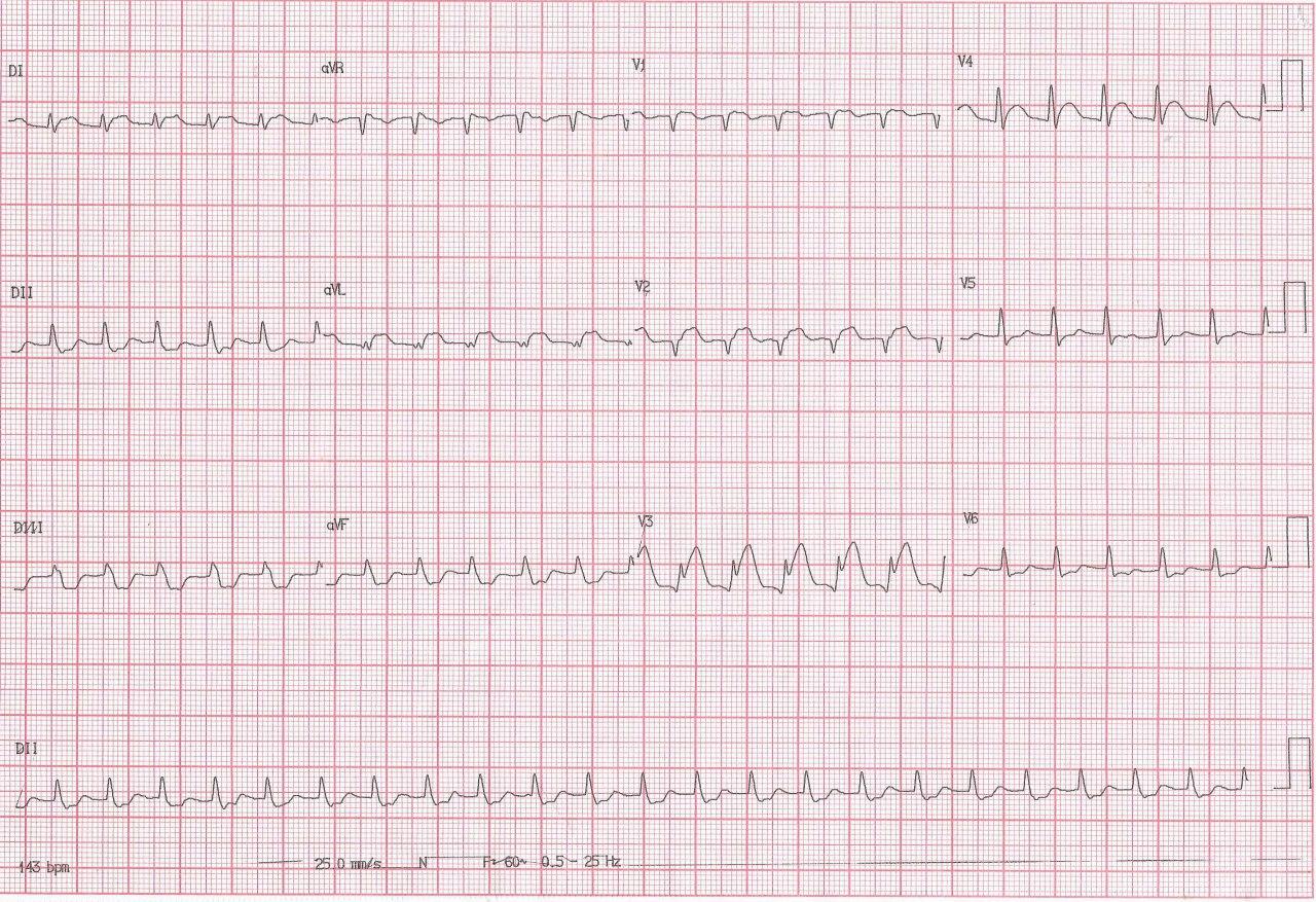 Hombre de 58 años, hipertenso con angor prolongado por SCA debido a compromiso de DA proximal + Cx, TCI like