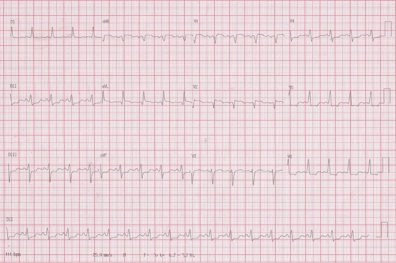 Mujer de 69 años con historia de infarto previo que consulta por angor constatándose lesión de TCI de 60%, obstrucción total de DA y lesión de Cx