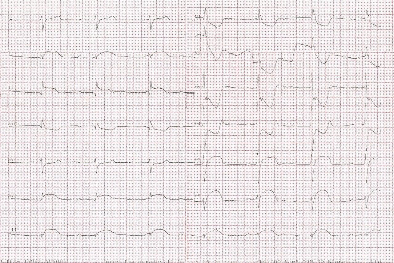 Mujer de 74 años con angor, disnea y síncope que presenta SCA con BAVC constatándose CD hipoplásica y suboclusión de la Cx