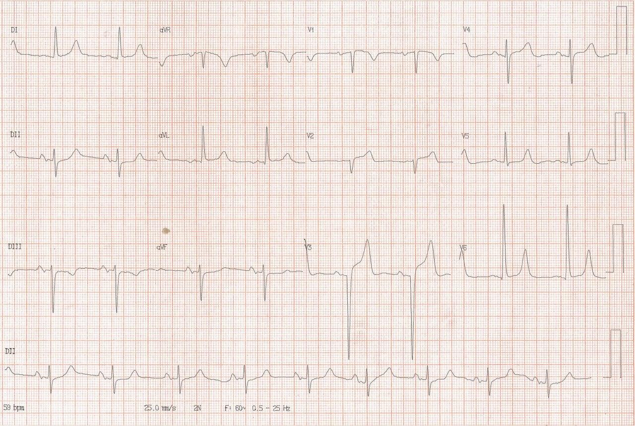 Hombre de 74 años, hipertenso y diabético con angor prolongado cuyo ECG muestra BIA-A y signos de isquemia grado I por compromiso de la DA