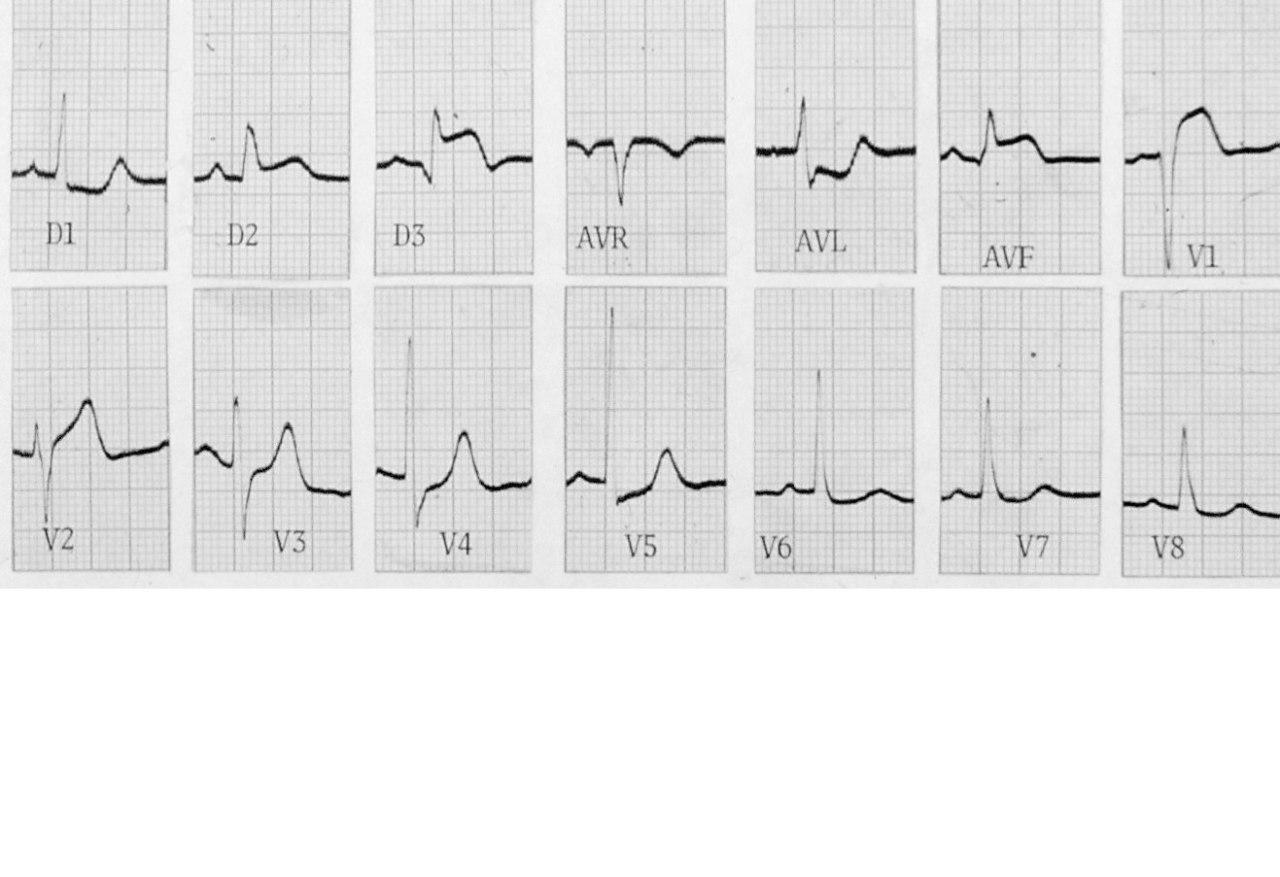 Paciente portador de SCA por compromiso de CD proximal, que se extiende a VD y presenta una TV polimorfa debida a la presencia de fenómeno R/T