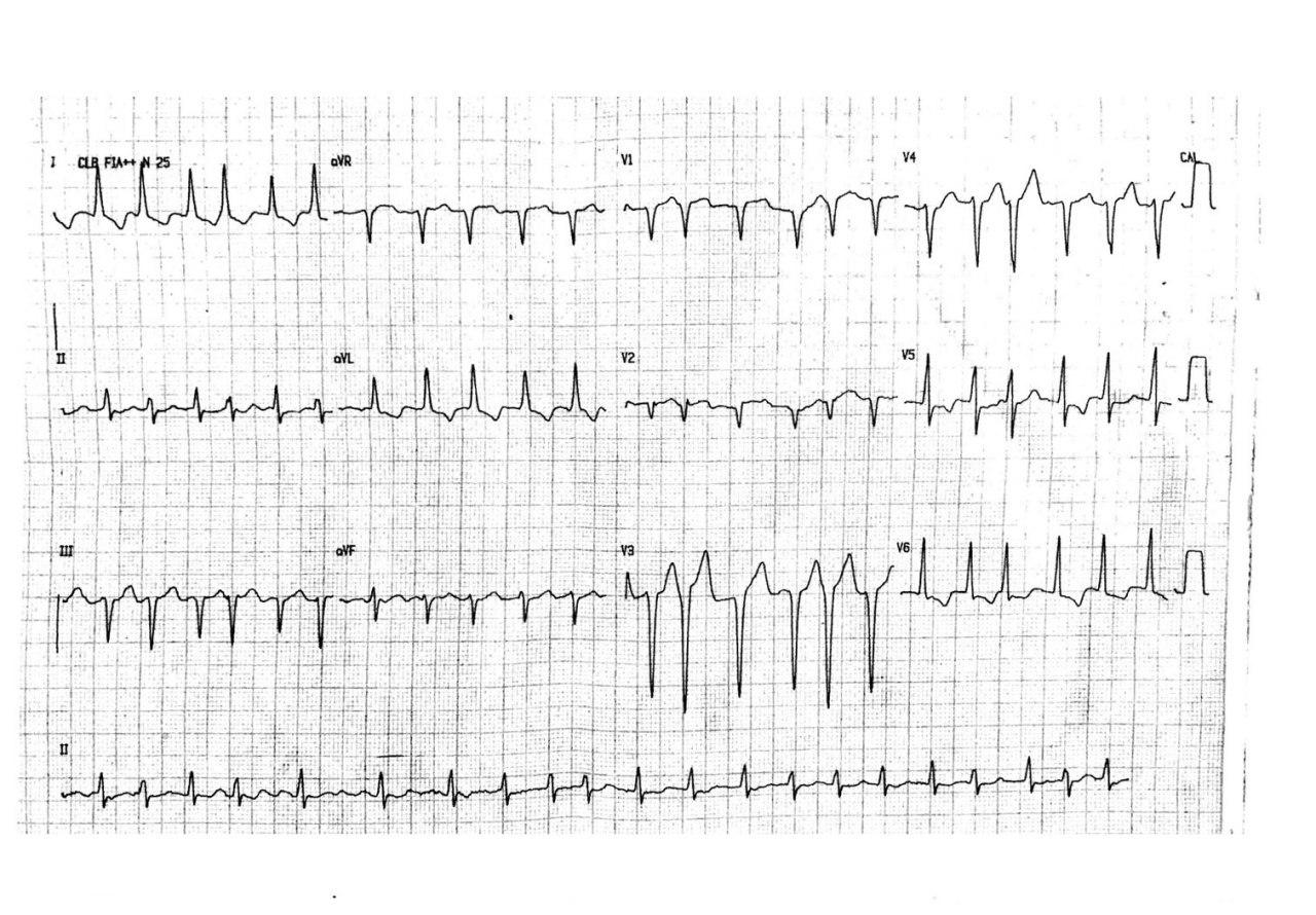 Hombre de 55 años con disnea, angor y palpitaciones por presentar fibrilación auricular de alta frecuencia en el contexto de una miocardiopatía hipertrófica obstructiva