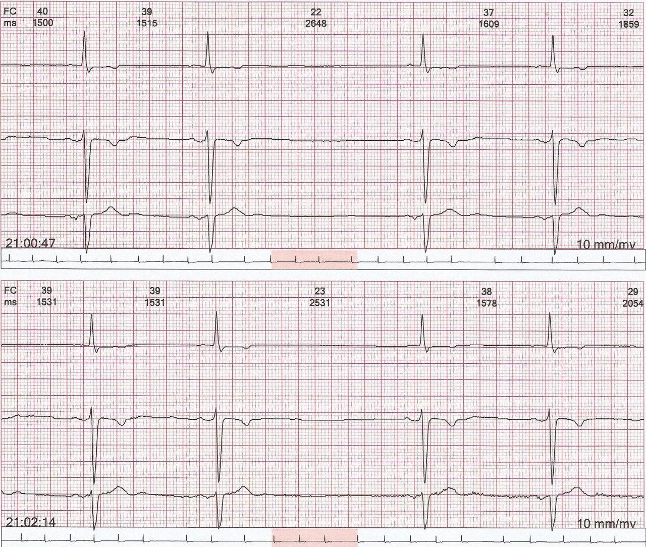 Mujer de 97 años con historia previa de FA que presenta paro sinusal en contexto de enfermedad del nódulo sinusal y enfermedad de Bayés