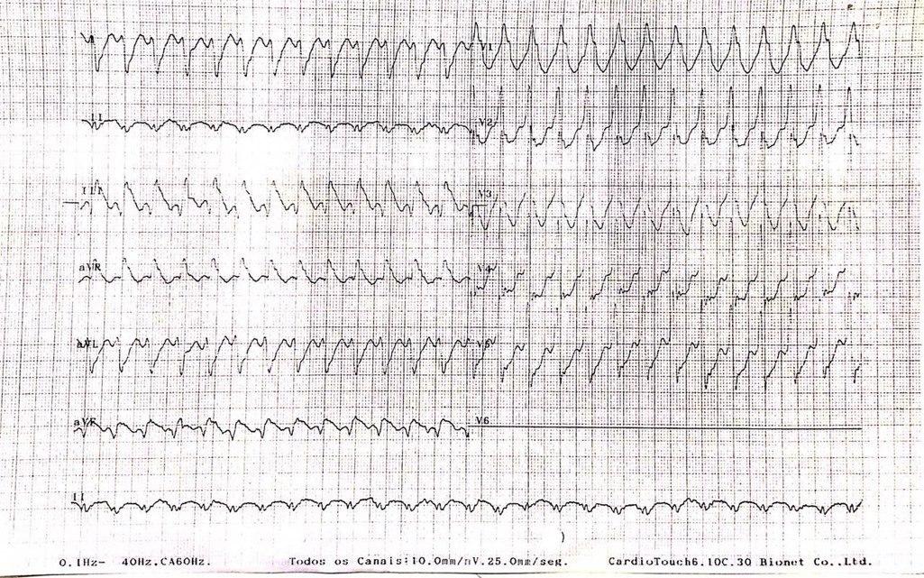 Mujer de 84 años que presenta palpitaciones seguidas de síncope por TVMS que revierte post CVE en contexto de FEVI 32% e hipoquinesia y fibrosis de cara inferior