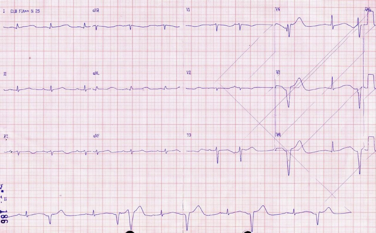 Paciente sometido a trombolisis con rt-PA y que presenta descenso del nivel de conciencia por hemorragia intracerebral que produce prolongación del QT