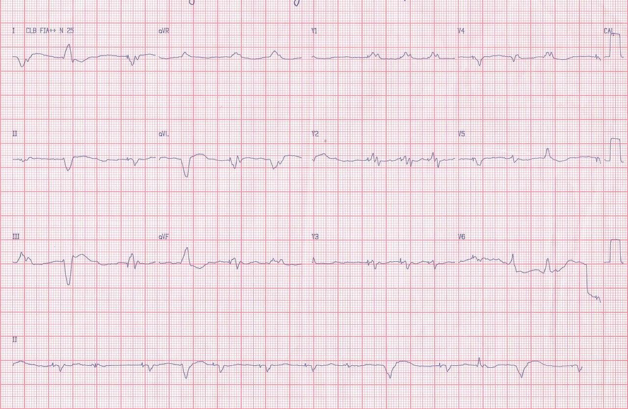 Mujer de 39 años portadora de severa miocardiopatía con implante de CDI-R que es sometida a transplante cardíaco que permite diagnosticar miocardiopatía esponjosa biventricular en el órgano explantado