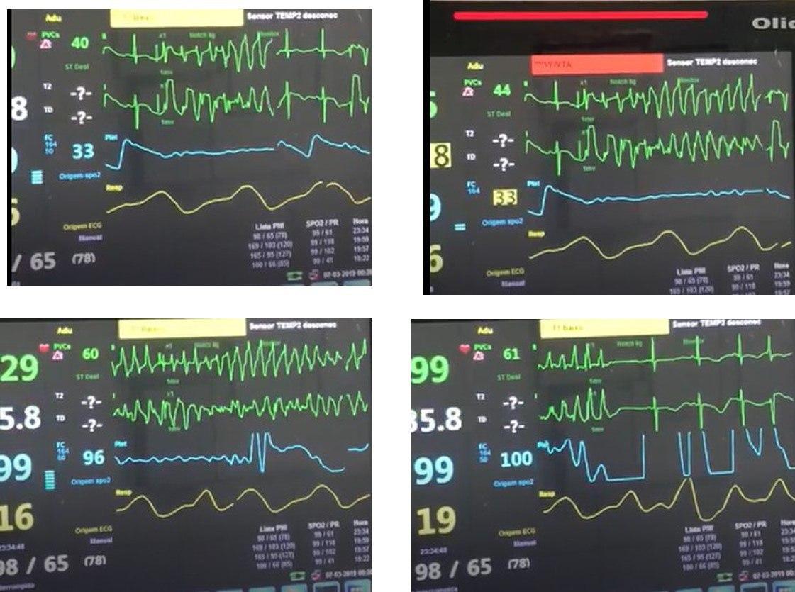 Mujer de 36 años con cuadro de colangitis que es tratada con ciprofloxacina presentado síncope que corresponde a episodio de Torsade de Pointe atribuible a presencia de SQTL
