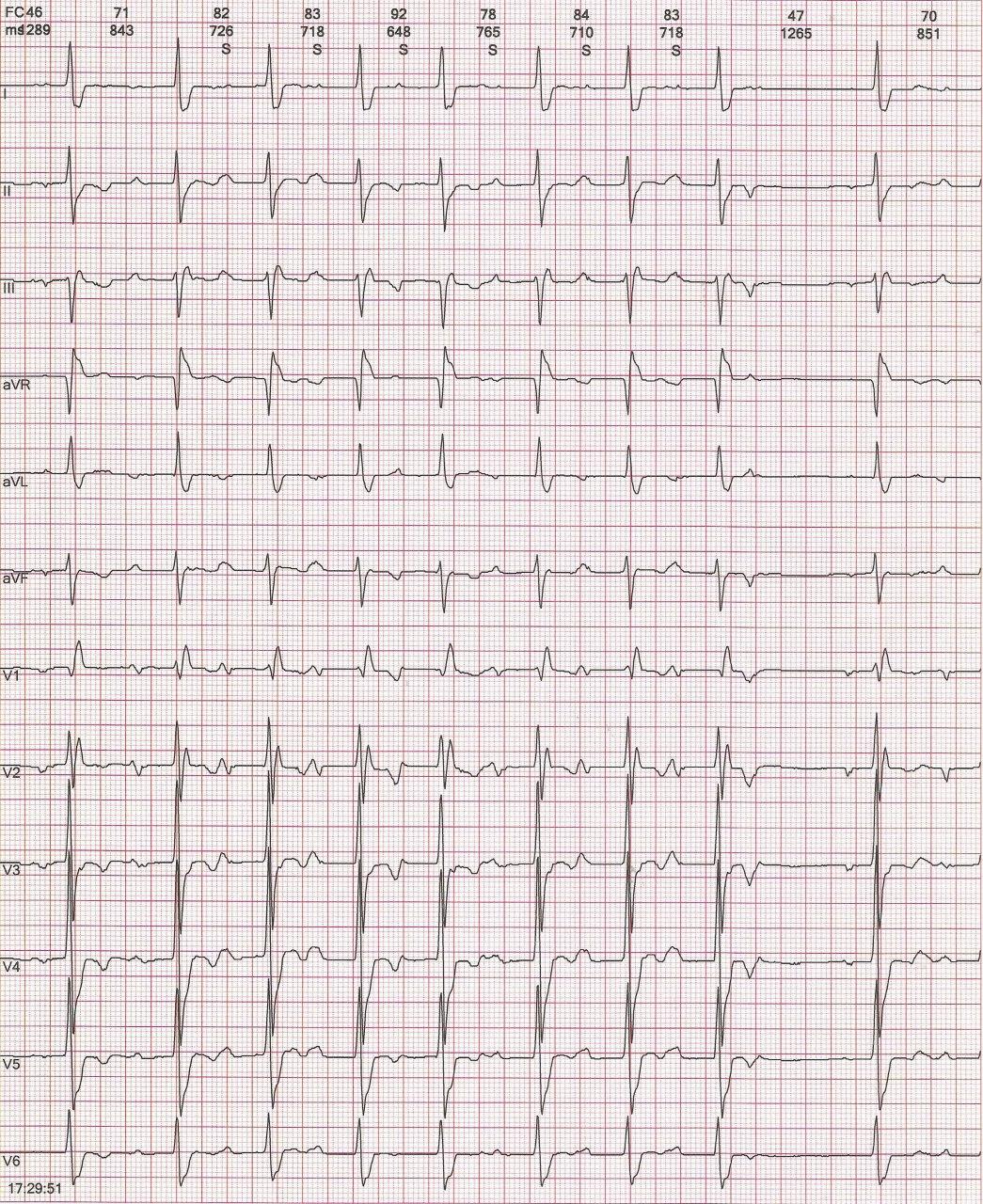 Paciente de 81 años con mareos y palpitaciones con BIA-A que presenta pausas prolongadas debido a extrasístoles auriculares bloqueadas