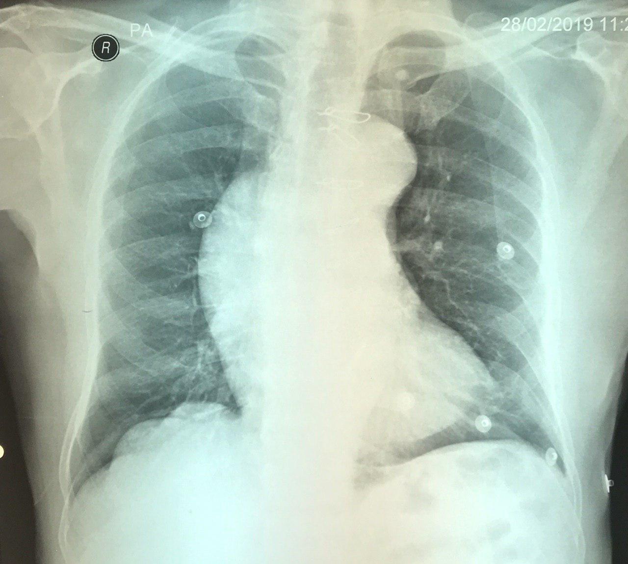 Reemplazo valvular aórtico hace 10 años por bicúspide aórtica con enfermedad valvular que presenta severa dilatación aneurismática y disección aórtica