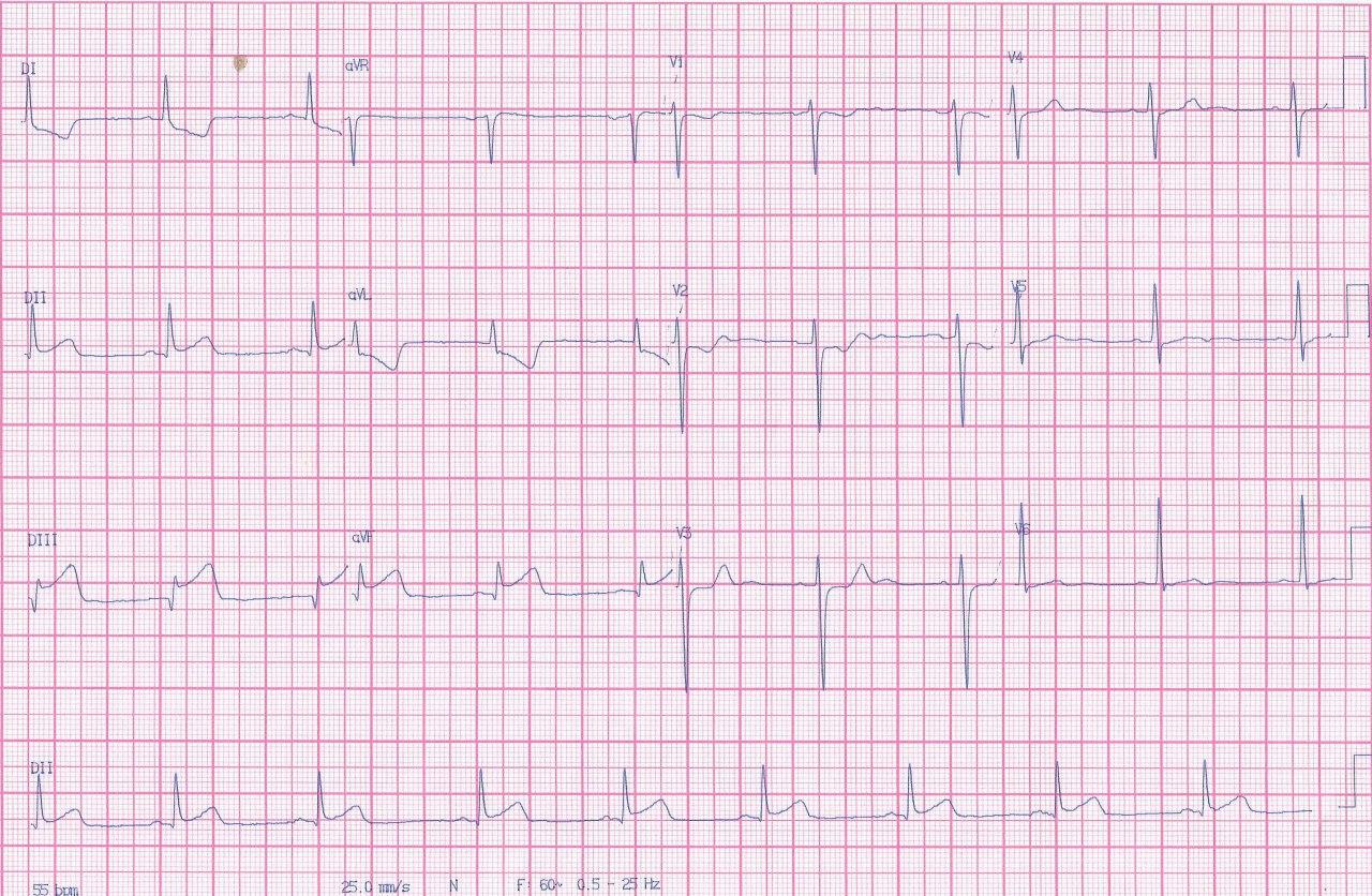Masculino de 35 años que presenta episodio de angor de reposo cuya CCG muestra múltiples dilataciones aneurismáticas coronarias por arteritis difusa de causa no especificada