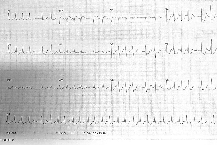 Mujer de 77 años con palpitaciones y síncope que presenta FA y luego aleteo auricular 2:1 con CCG y ventriculograma normales