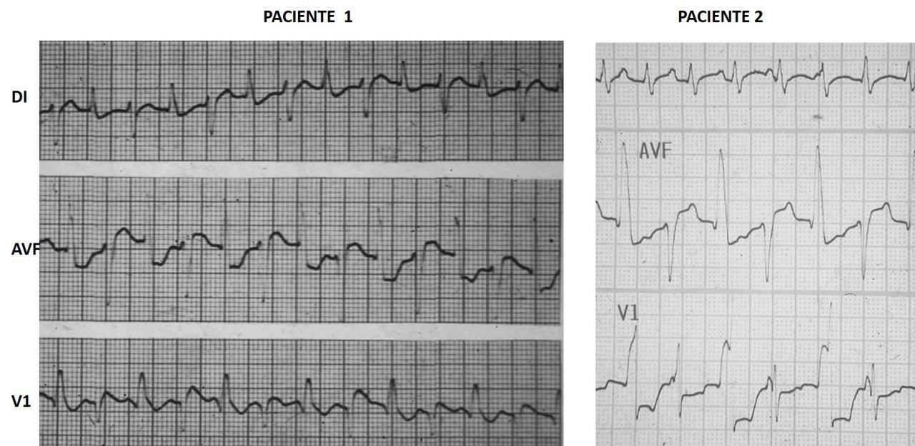 Dos casos de TV bidireccional como expresión de intoxicación digitálica en pacientes con FA