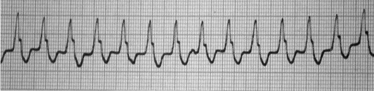 Paciente que presenta taquicardia regular de QRS ancho en quién se realiza ECG intraesofágico que permite confirmar el diagnóstico de Taquicardia Ventricular