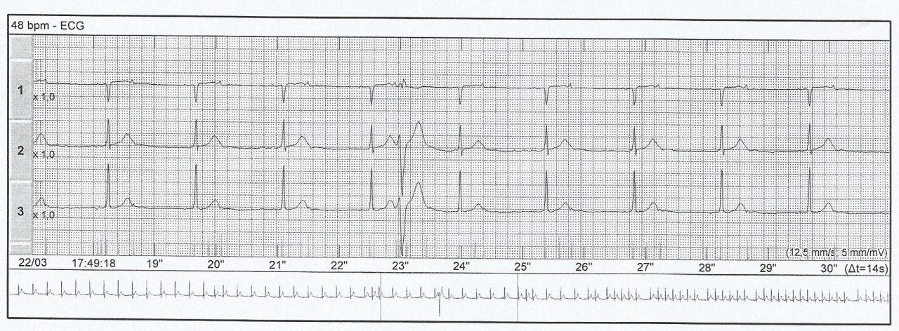 Paciente con palpitaciones en cuyo Holter se detecta taquicardia auricular y extrasístoles auriculares bloquedas dando la apariencia de pseudo bradicardia y que además presenta BIA-A