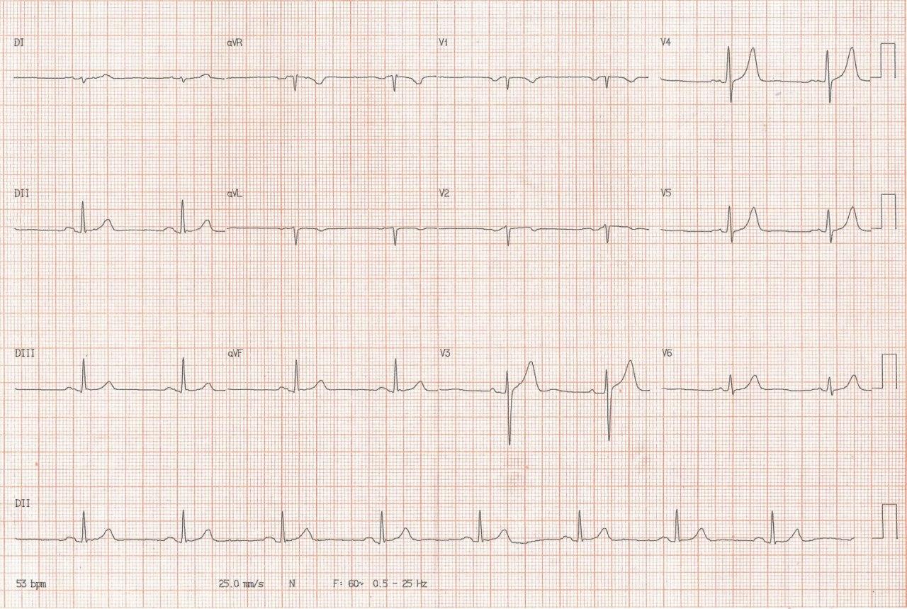 Hombre de 48 años con palpitaciones y dolor precordial de esfuerzo que presenta estenosis mitral que es tratada con valvuloplastia
