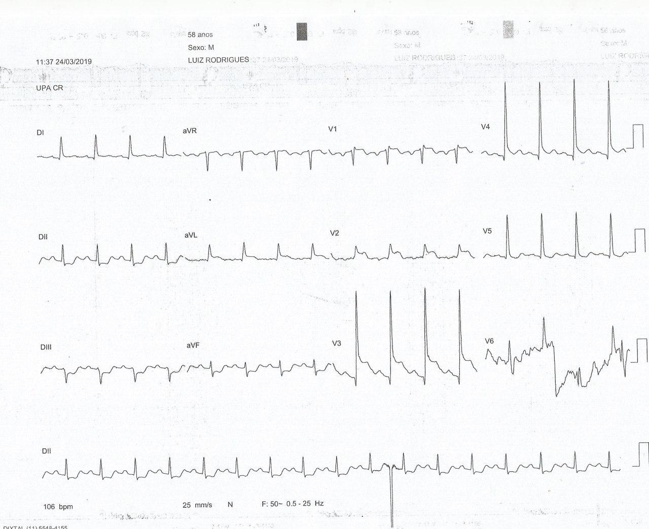 Hombre de 58 años con intenso ardor precordial y mareos con SCACEST por compromiso de DA proximal que al ser tratado presenta reperfusión incompleta evidenciada por ondas T plus/minus