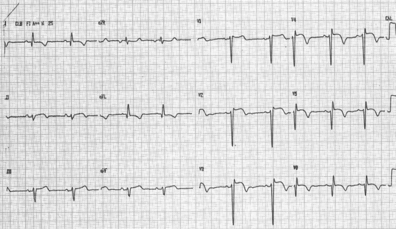 Paciente con historia de infarto previo y episodios sincopales, que presenta aneurisma ventricular con signo de El-Sherif en el ECG