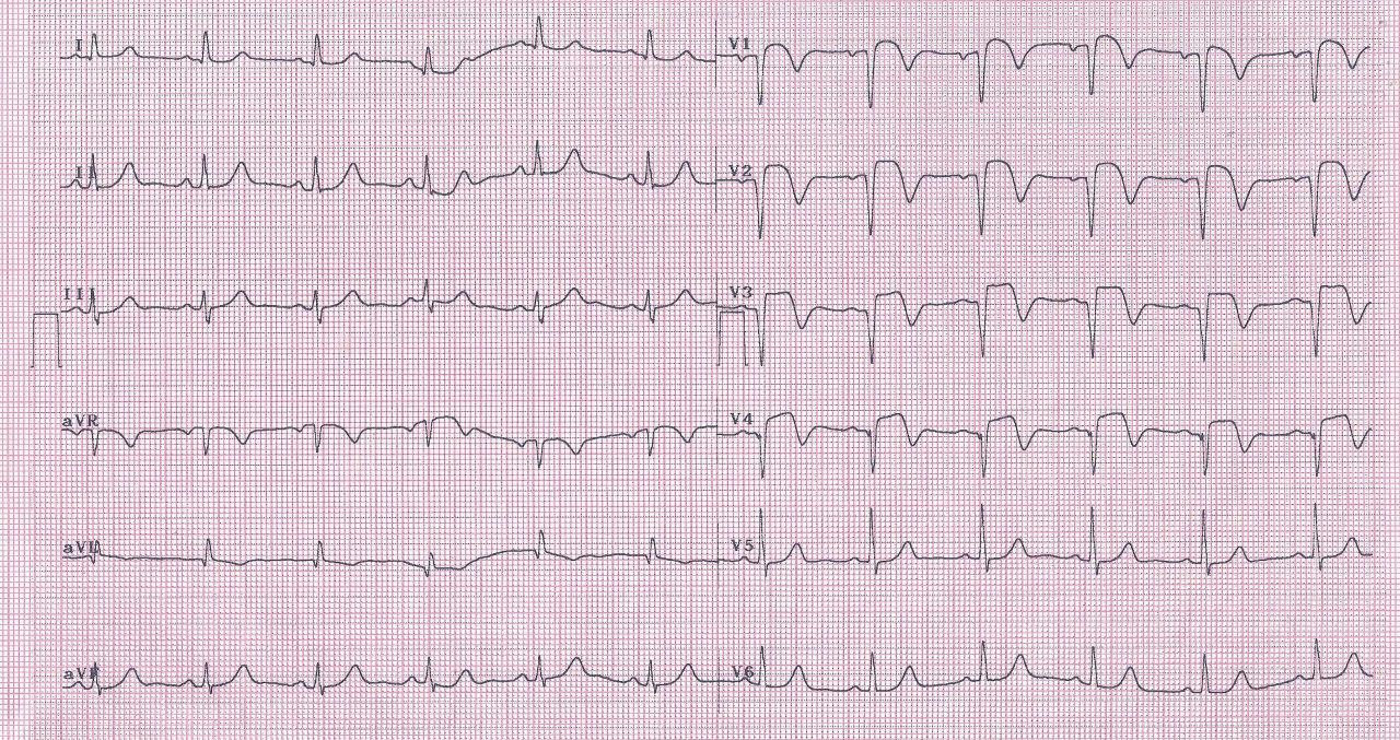 Mujer de 78 años, hipertensa y diabética con angor prolongado y arterias coronarias sin lesiones significativas, por síndrome de takotsubo con normalización de contracción a las 48 horas y persistencia de alteraciones ECG