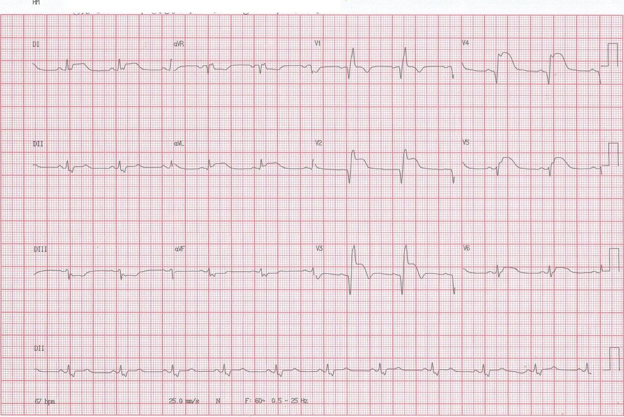 Hombre de 59 años con angor prolongado por infarto agudo de cara anterior complicado con BRD por compromiso de la arteria coronaria DA proximal