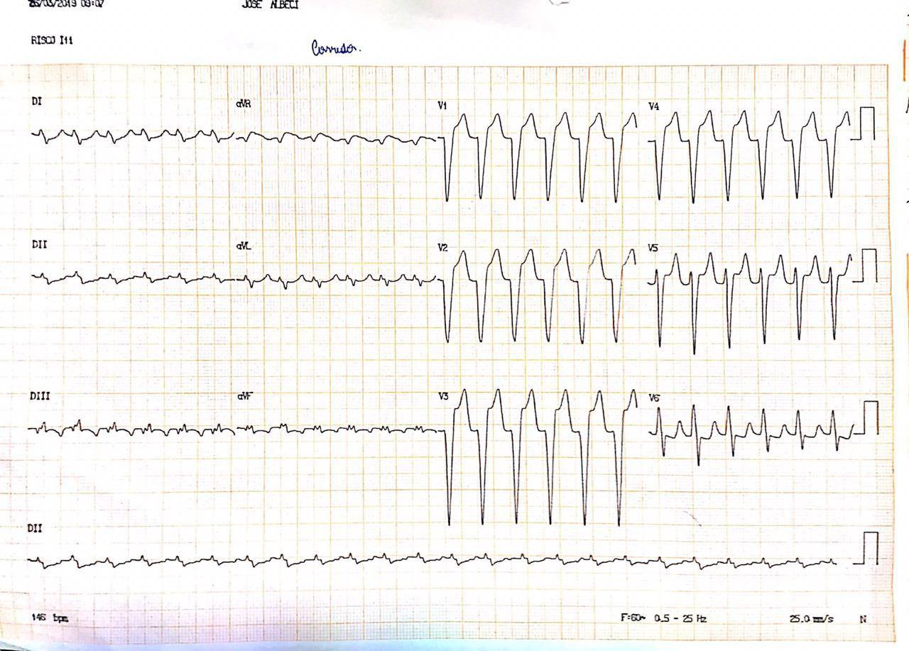 Hombre de 57 años con dolor precordial atípico, disnea y palpitaciones que presenta taquicardia auricular y en que la CCG constata embolia en CD distal comprometiendo ramo auricular