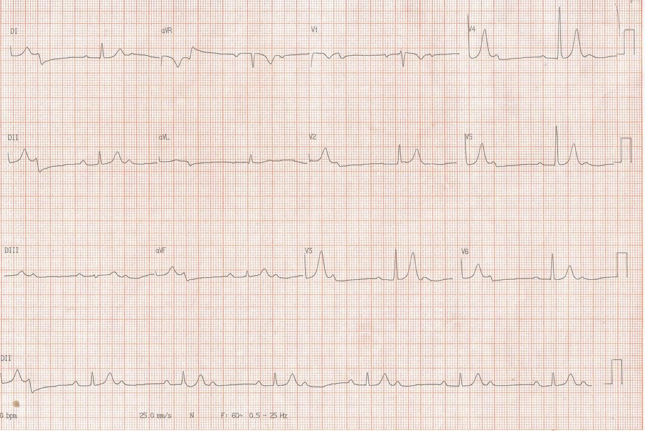 Paciente de 77 años con fatiga que presenta BAV 2:1 coexistiendo con BAV Mobitz 1 lo que permite sospechar que el nivel del bloqueo se encuentra en el NAV