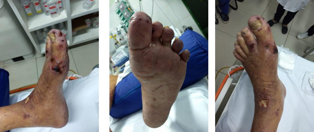 Paciente portador de valvulopatía mitral que cursa endocarditis infecciosa