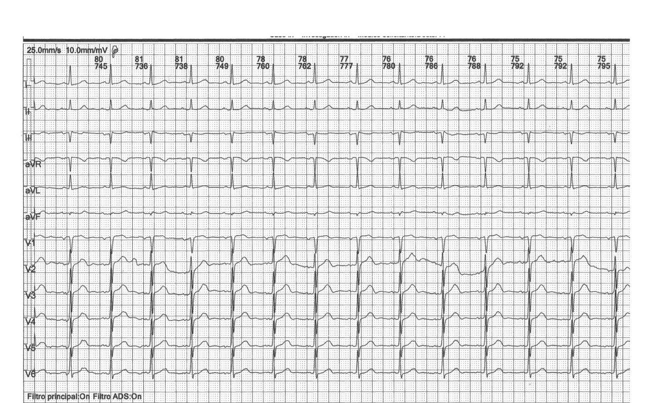 Paciente de 71 años que presenta FA paroxística que revierte a RS con amiodarona EV, detectándose Síndrome de Bayes y presencia de soplo carotídeo izquierdo demostrativo de estenosis
