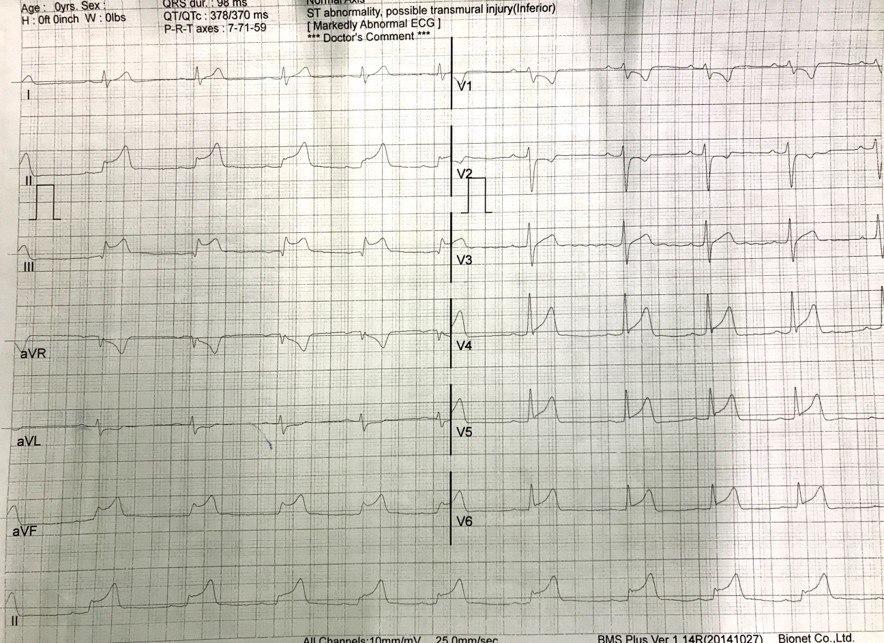 Joven de 19 años con angor prolongado post consumo de cocaína que presenta IAM en evolución con arterias coronarias normales