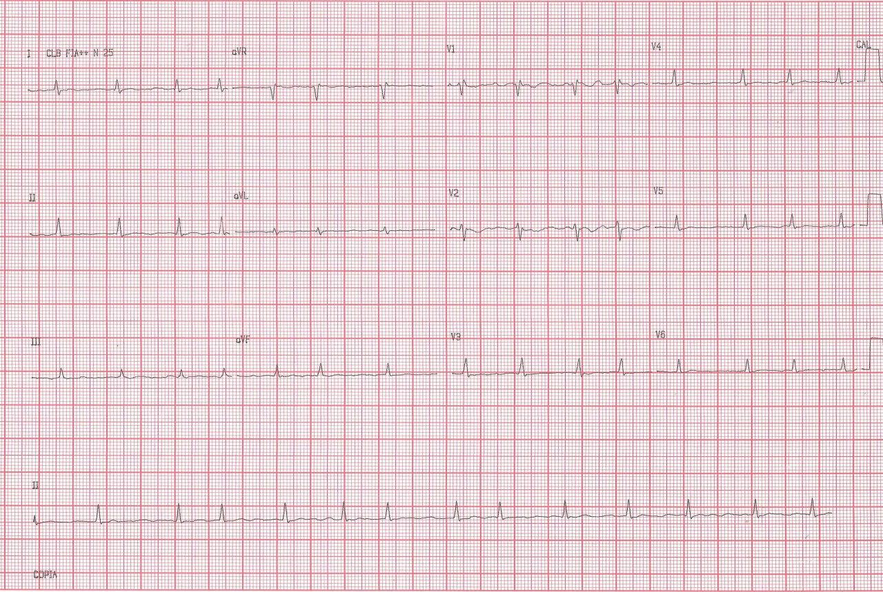 Mujer de 59 años portadora de estenosis mitral severa y antecedente de ACV que presenta fiebre, dolor pleurítico, esputos hemoptoicos y hemoptisis por embolia e infarto pulmonar