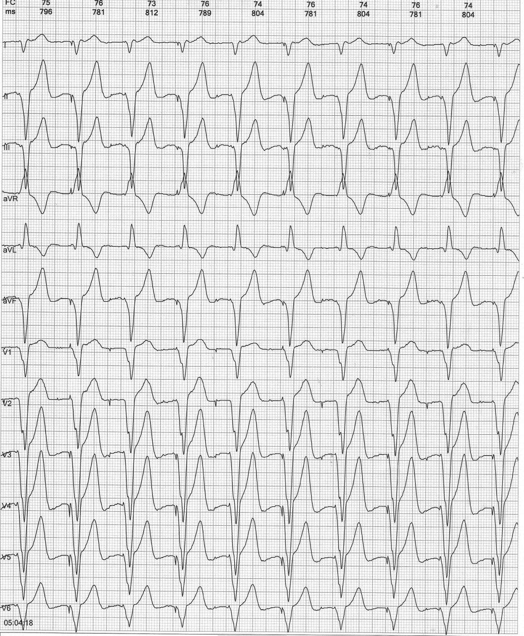 Paciente portador de marcapasos normofuncionante que permite constatar la electromodulación de la onda T post pacing