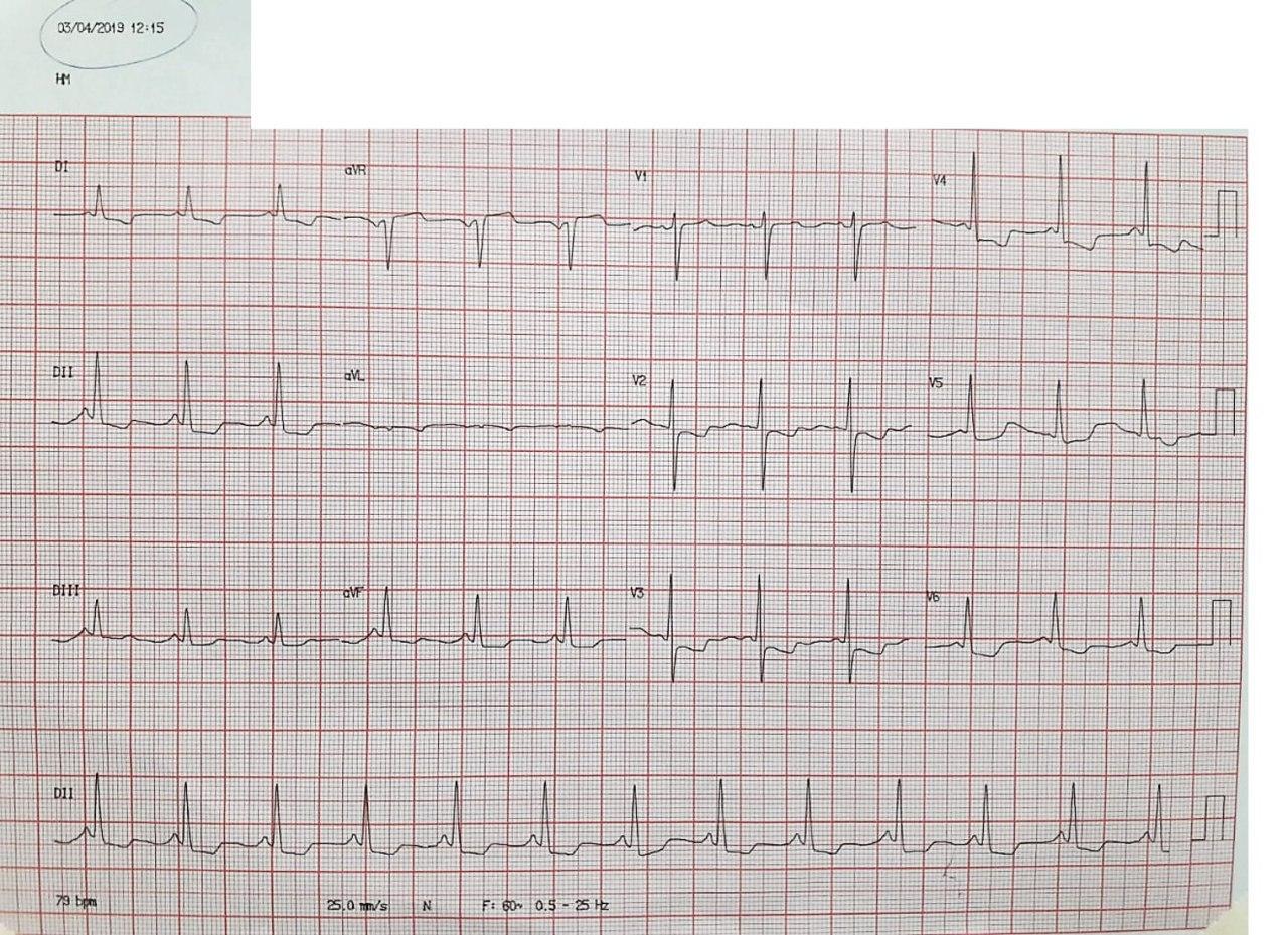 Mujer con antecedente de implante de stents en CD y Cx que presenta cuadro de angina progresiva por trombosis intrastents y desarrollo ulterior de infarto auricular por compromiso de la arteria del nódulo sinoauricular