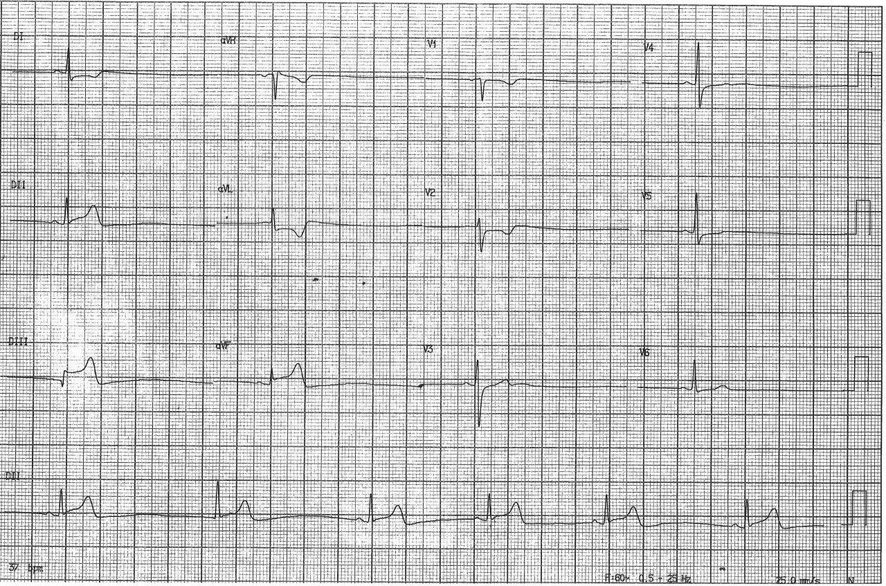 Mujer de 69 años con factores de riesgo que cursa con episodio de angor prolongado por espasmo en CD determinando ritmo de escape nodal en contexto de injuria de cara inferior