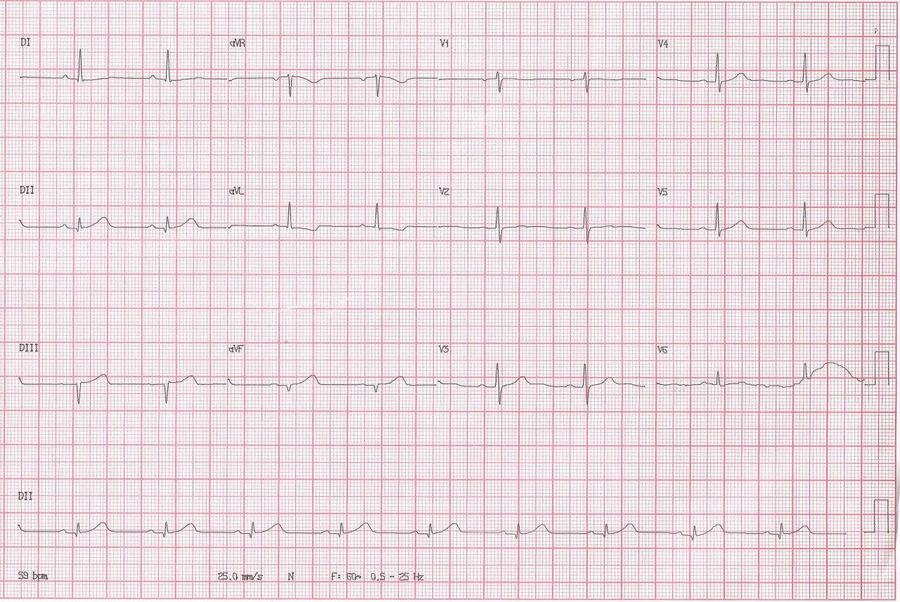 Paciente masculino de 47 años con antecedentes familiares de enfermedad coronaria que presenta episodio de angor prolongado por SCA de cara inferior mostrando depresión del ST en aVL, signo más sensible de isquemia de cara inferior