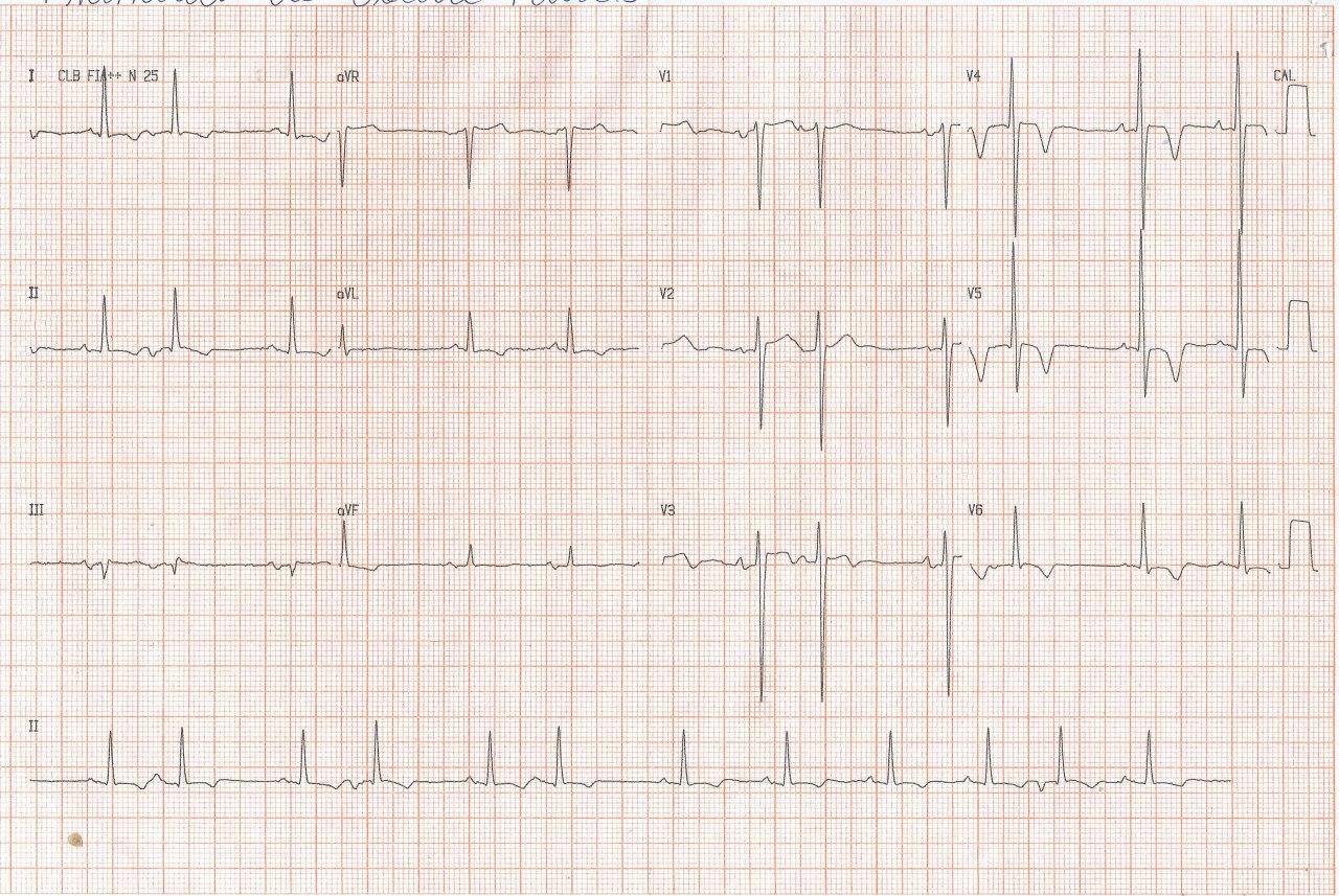 Mujer de 71 años con antecedente de cirugía de revascularización miocárdica hace 10 años que presenta disnea progresiva atribuible a severa estenosis valvular aórtica y estenosis mitral leve