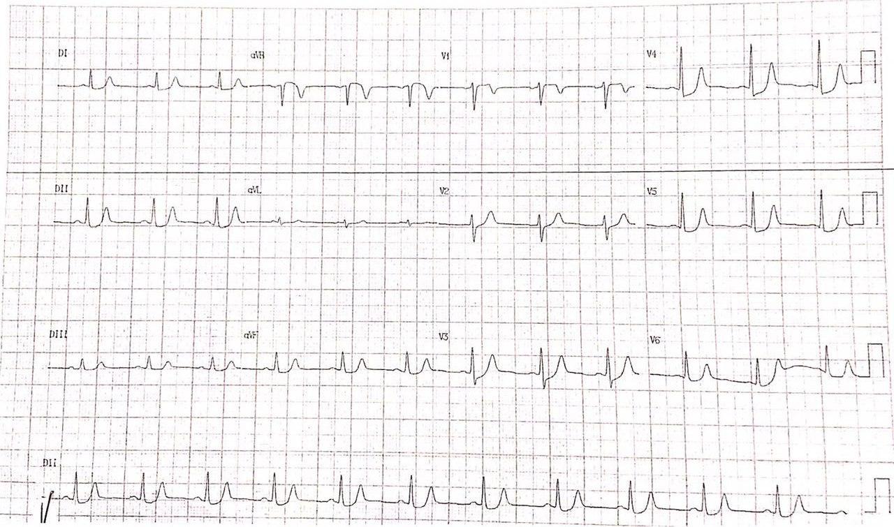 Paciente de 48 años que presenta angor de reposo por presencia de puente muscular sobre la DA asociado a espasmo y trombosis local