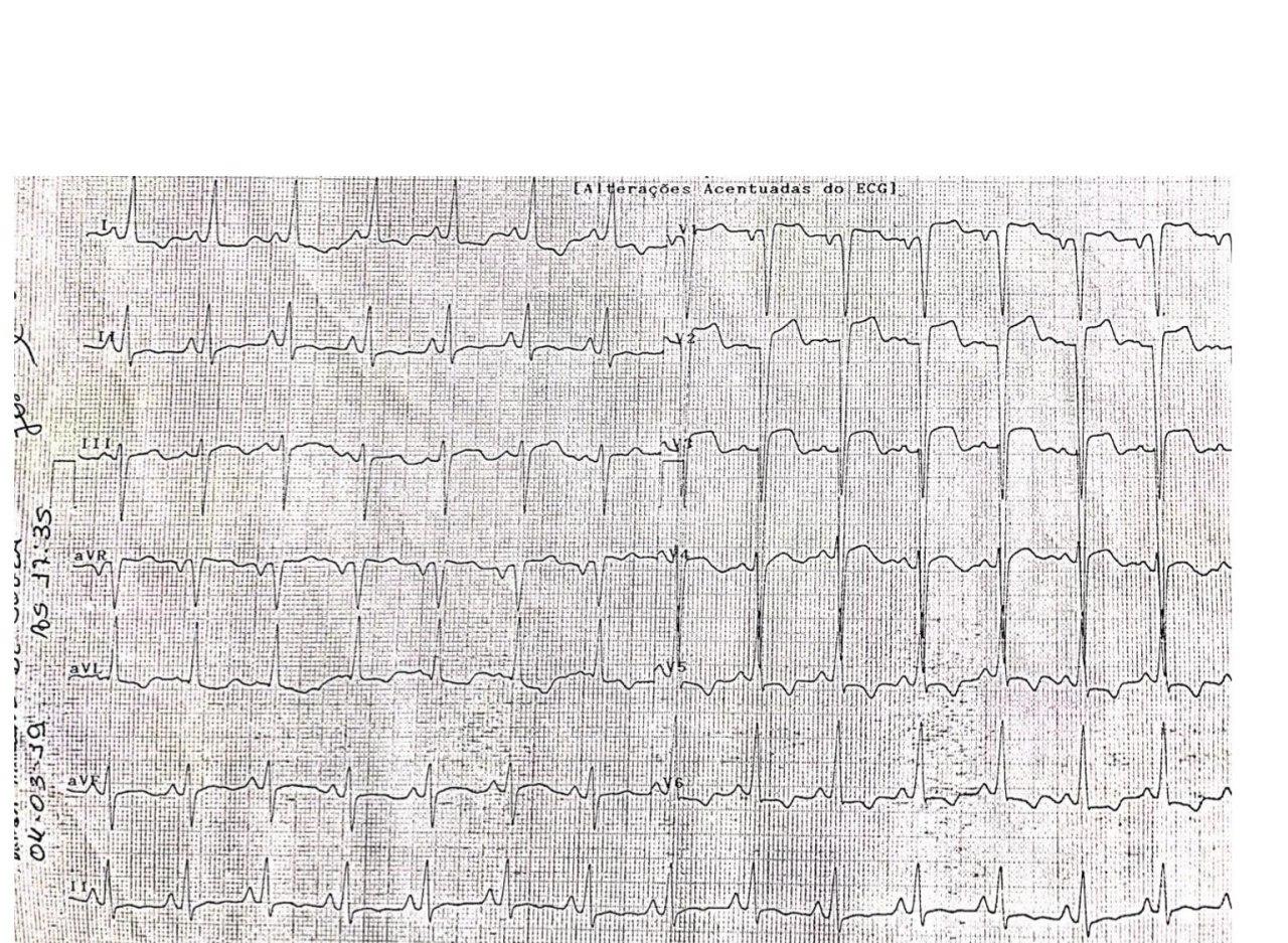 Mujer de 53 años, usuaria de crack y cocaína, con cuadro de angina de reciente comienzo por lesión ostial bilateral de etiología sifilítica