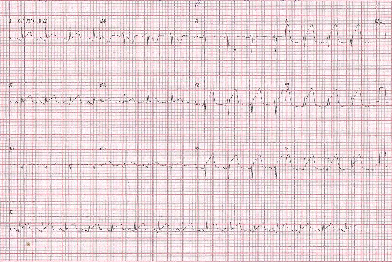 Hombre de 34 años que presenta episodio de angor prolongado luego de consumo de bebida energizante con alto contenido en cafeína que presenta trombo en la DA