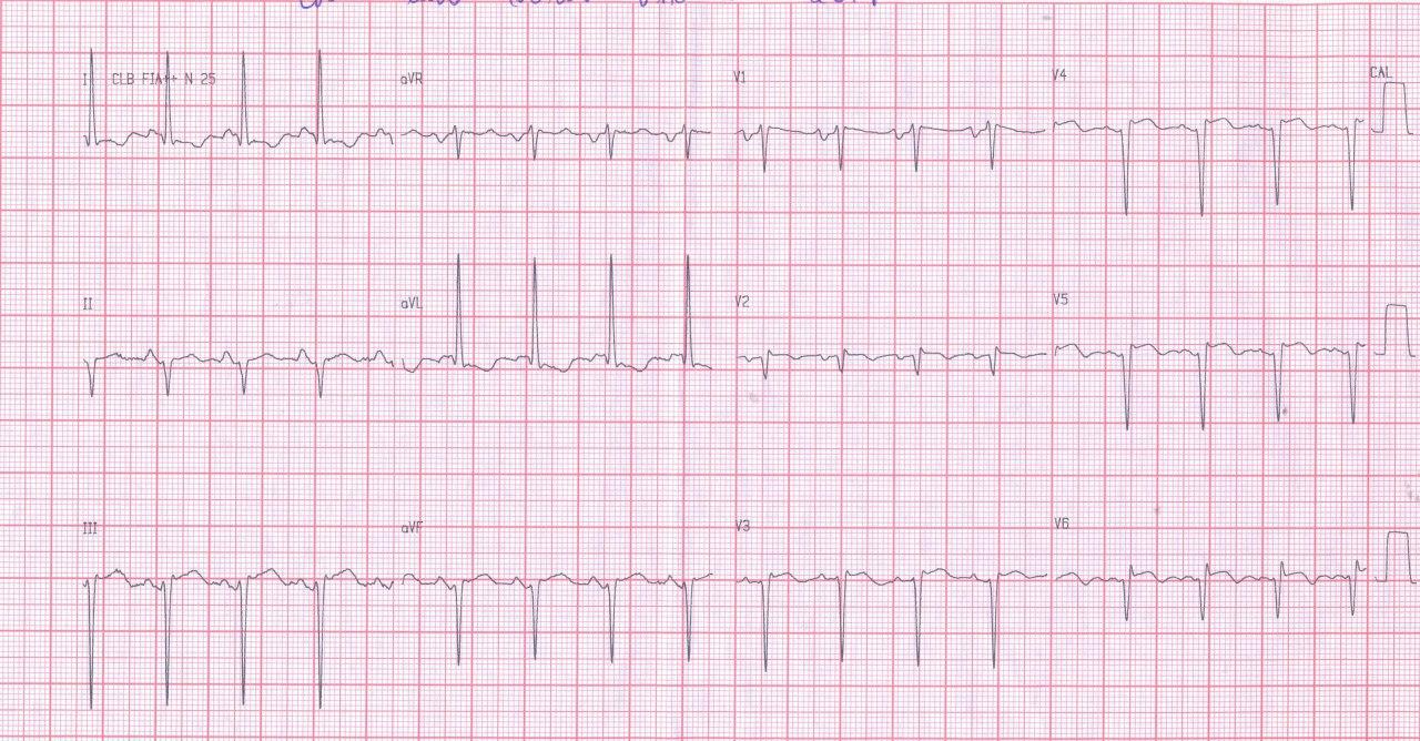 Mujer de 72 años con factores de riesgo e infarto previo que presenta disnea progresiva por la presencia de aneurisma apical y compromiso de DA 100%