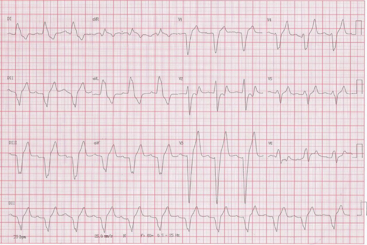 Paciente de 90 años que presenta episodio sincopal por presentar BCRI que evoluciona presentando al día siguiente BAVC