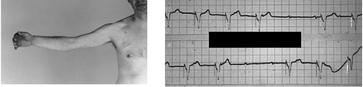 Paciente portador de marcapasos VVI desde hace 5 años que refiere mareos al mover el brazo derecho atribuibles a fractura de cable