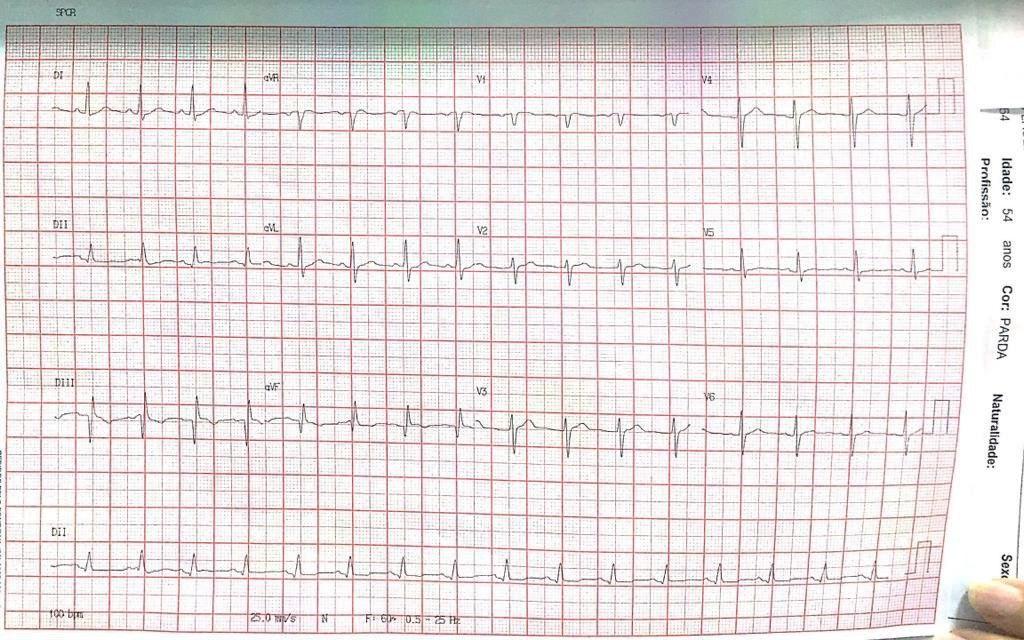 Hombre de 53 años que desarrolla tromboflebitis profunda en MI a posteriori de mordedura de gato presentando a posteriori disnea súbita por TEP bilateral