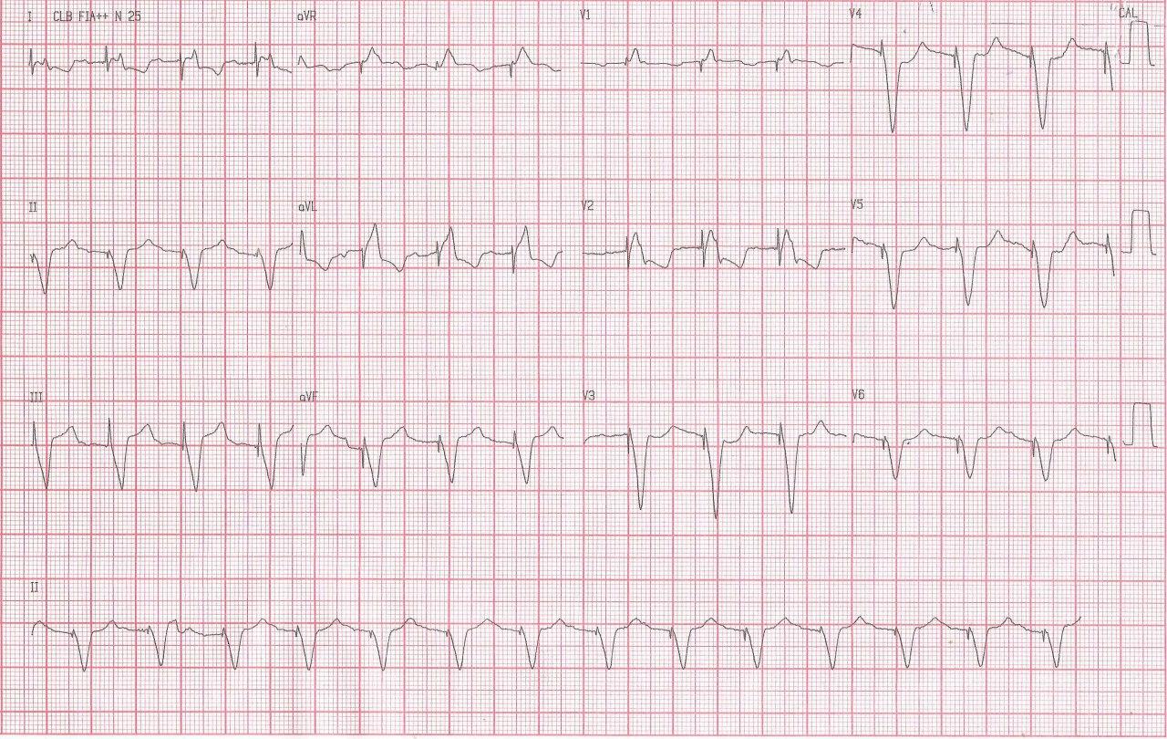 Hombre de 67 años portador de marcapasos que presenta angor prolongado por SCA por compromiso multivasos con suboclusión de Cx y 80% de CD con criterio de Sgarbosa positivo