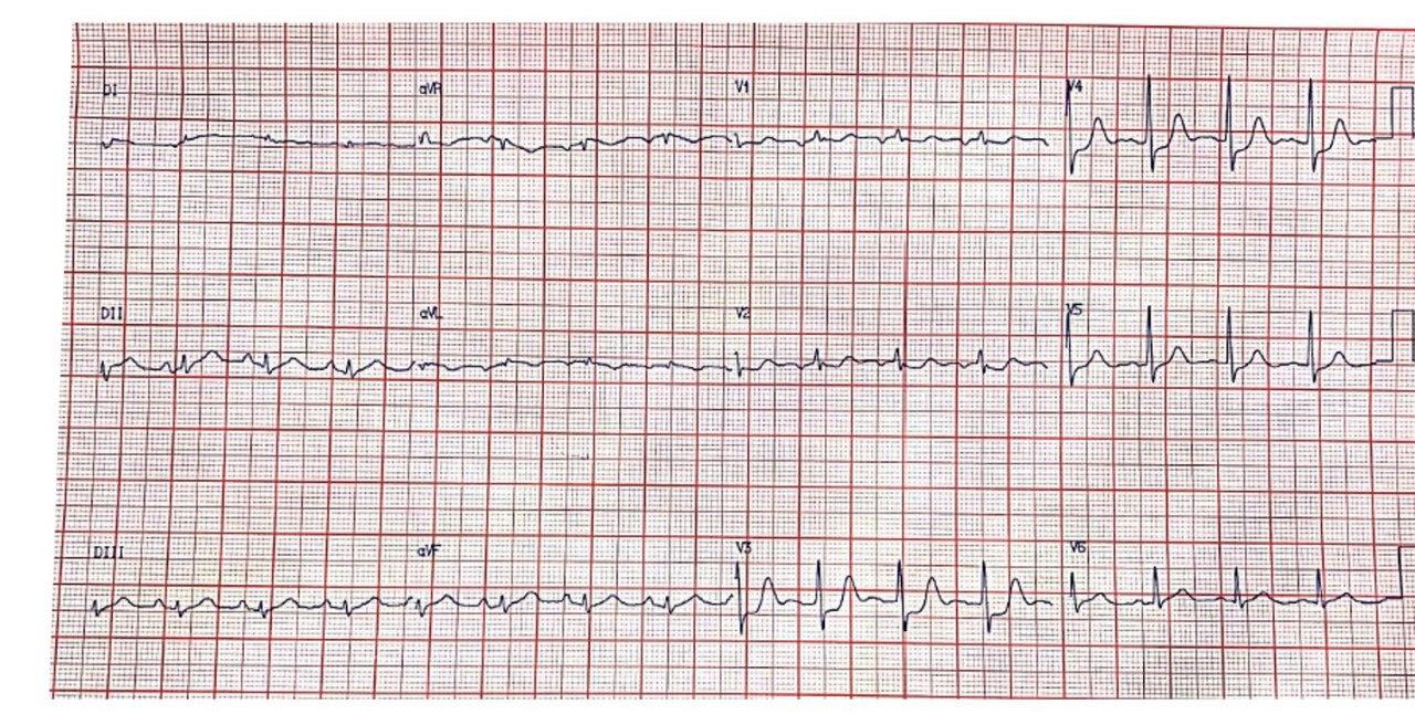 Mujer de 73 años hipertensa y diabética que cursa con angor prolongado por SCACEST ínferobasal por compromiso de Cx