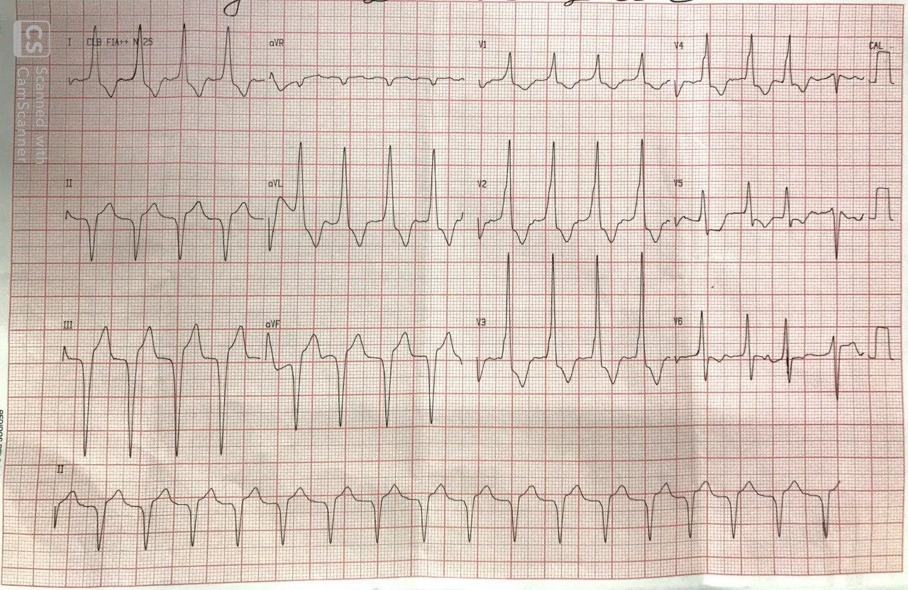 Paciente masculino de 66 años portador de miocardiopatía isquémica y antecedente de reemplazo valvular mitral que presenta incremento de su disnea habitual y vuyo ECG muestra bloqueo tetrafascicular